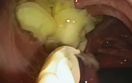 Gia tăng ca nhiễm sán lá gan nhỏ, sán dây lợn