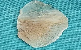 Bé trai suýt thủng thực quản vì hóc xương cá ba sa