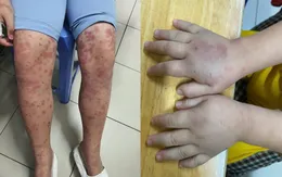 Cẩn trọng với ban xuất huyết Schonlein- Henoch ở trẻ