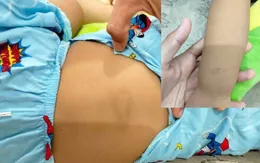 Bình Thuận: Cháu bé 3 tuổi nghi bị bạo hành tại điểm giữ trẻ tự phát
