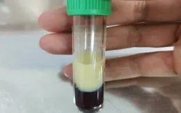 Không tuân thủ điều trị, bệnh nhân nhập viện vì viêm tụy cấp do triglycerid tăng kịch phát