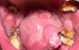Ung thư khoang miệng: Các biểu hiện ban đầu thường gặp