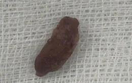 Hiếm gặp: Phẫu thuật lấy sỏi 15mm trong bao quy đầu do hẹp kéo dài