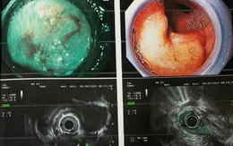 Thoát ung thư nhờ tầm soát sớm: Câu chuyện của người đàn ông mắc 2 ung thư đường tiêu hóa