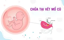 Chửa tại vết mổ cũ: Nguy cơ vỡ tử cung, đe dọa tính mạng