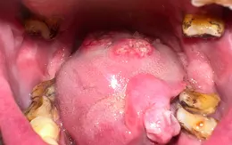 Loét miệng kéo dài - đừng chủ quan, có thể là ung thư khoang miệng