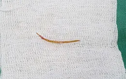 Liên tiếp 3 ca thủng nội tạng do xương cá, bác sĩ cảnh báo nguy cơ tử vong