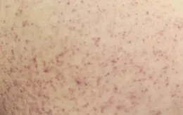 Cô gái 21 tuổi suýt mất mạng vì sốc sốt xuất huyết Dengue nặng