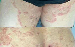 Phát hiện sớm giang mai - nấm da, điều trị đúng để ngăn biến chứng