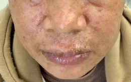 Viêm da nặng, suy thượng thận do mỹ phẩm làm trắng không rõ nguồn gốc