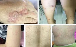 Giun đũa chó mèo: Nguy cơ âm thầm trong mỗi gia đình nuôi thú cưng