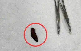 Cảnh báo tai nạn lao động: Mảnh kim loại ghim sâu vào đùi khi cắt cỏ