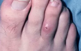 Mexico ghi nhận thêm 2 ca mắc bệnh giòi "ăn thịt" người