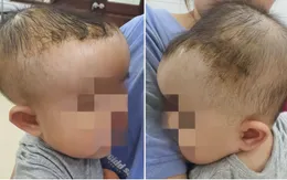 Bé 7 tháng tuổi bị tụ máu đầu do ngã giường