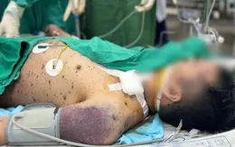 Biến chứng thủy đậu nguy kịch: Một ca xin về, một ca vẫn thở máy