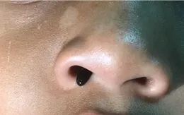 Đỉa ký sinh trong mũi gây ho ra máu suốt 7 ngày cho bé gái 5 tuổi