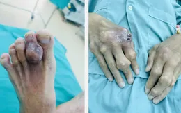Hạt Tophi - Cảnh báo biến chứng nguy hiểm ở người bệnh gout