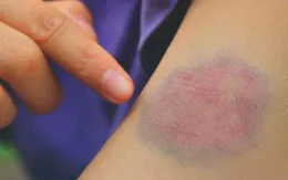 Tiểu cầu và những "vết bầm tím" đáng ngờ