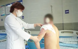 Bất cẩn để ngọn lửa bén vào xăng gây bỏng nặng vùng mặt