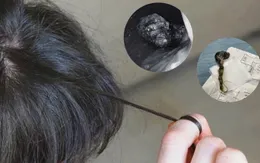 Bé trai 7 tuổi mắc hội chứng Rapunzel do ăn tóc gây tắc ruột