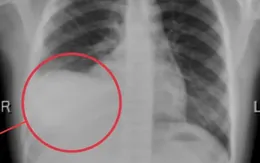 Cảnh báo tràn dịch màng phổi ở trẻ: Nguy hiểm nếu chậm phát hiện