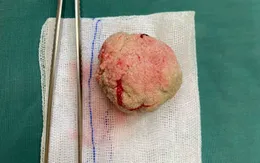Cụ ông 98 tuổi mang viên sỏi bàng quang to như quả trứng gà