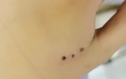 Vết cắn nhỏ - hiểm họa lớn từ chuột