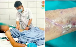 Cảnh báo uốn ván sau vết thương nhỏ