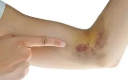 Ung thư máu không phải bản án tử: Cảnh báo những hiểu lầm nguy hiểm