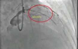 Cứu sống cụ ông 90 tuổi nhồi máu cơ tim giữa đêm