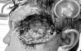 Hoại tử mặt vì tự đổ thuốc diệt cỏ vào vết thương