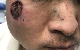 Ung thư biểu mô tế bào đáy ở người trẻ: Dễ bị bỏ sót do nhầm lẫn lâm sàng