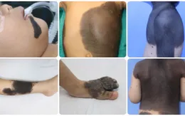Nơ vi hắc tố bẩm sinh: Đừng xem nhẹ vết bớt của trẻ
