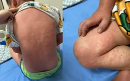 Cảnh báo ban nhiễm trùng ở trẻ: Không nên chủ quan với triệu chứng ngoài da