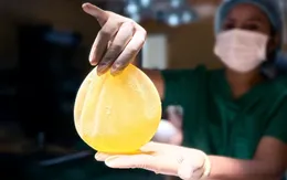 Co thắt bao xơ tái phát là gì?