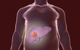 Sỏi mật: Đừng chủ quan vì có thể gây ung thư đường mật