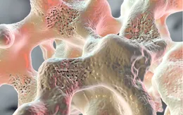 Nguy cơ gãy xương vì loãng xương tăng cao sau tuổi 50