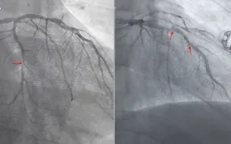 Thoát chết hy hữu: Cụ bà 74 tuổi vượt nhồi máu cơ tim, đột quỵ trong một tuần