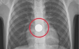 Nguy hiểm từ hóc dị vật: Chủ đề không mới nhưng không thể lơ là