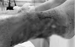 Lóc da cẳng chân do tai nạn - Bệnh nhân đái tháo đường đối mặt nguy cơ hoại tử