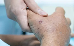 Sống sót kỳ diệu sau khi bị ong vò vẽ đốt hơn 30 vết, hôn mê nguy kịch