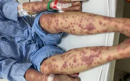 Nguy kịch vì dùng thuốc giảm cân, collagen không rõ nguồn gốc