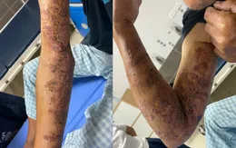 Cứu chữa kịp thời ca zona thần kinh bội nhiễm nguy hiểm