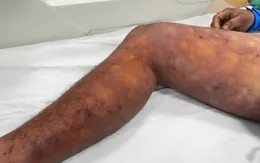 TP Huế: 12 ca liên cầu lợn, 1 người tử vong - Cảnh báo nguy cơ từ thịt sống, tiết canh