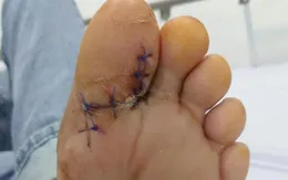 Phát hiện đái tháo đường type 2 từ vết thương bàn chân lâu lành