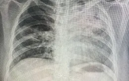 Lao phổi trẻ hóa, nhiều ca phát hiện nhờ X-quang ngực