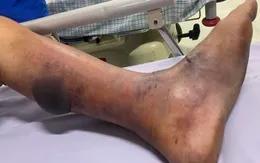 Hà Nội cảnh báo về bệnh liên cầu lợn