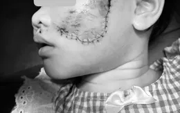 Nguy cơ từ vật nuôi: Nỗi lo từ những vết thương trên mặt trẻ nhỏ