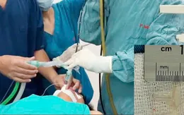 Gắp thành công dị vật đuôi bút bi gây xẹp phổi ở bé trai 12 tuổi