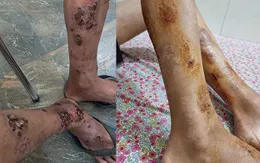 Tự ý đắp thuốc nam, nam sinh bị viêm da nhiễm khuẩn nặng